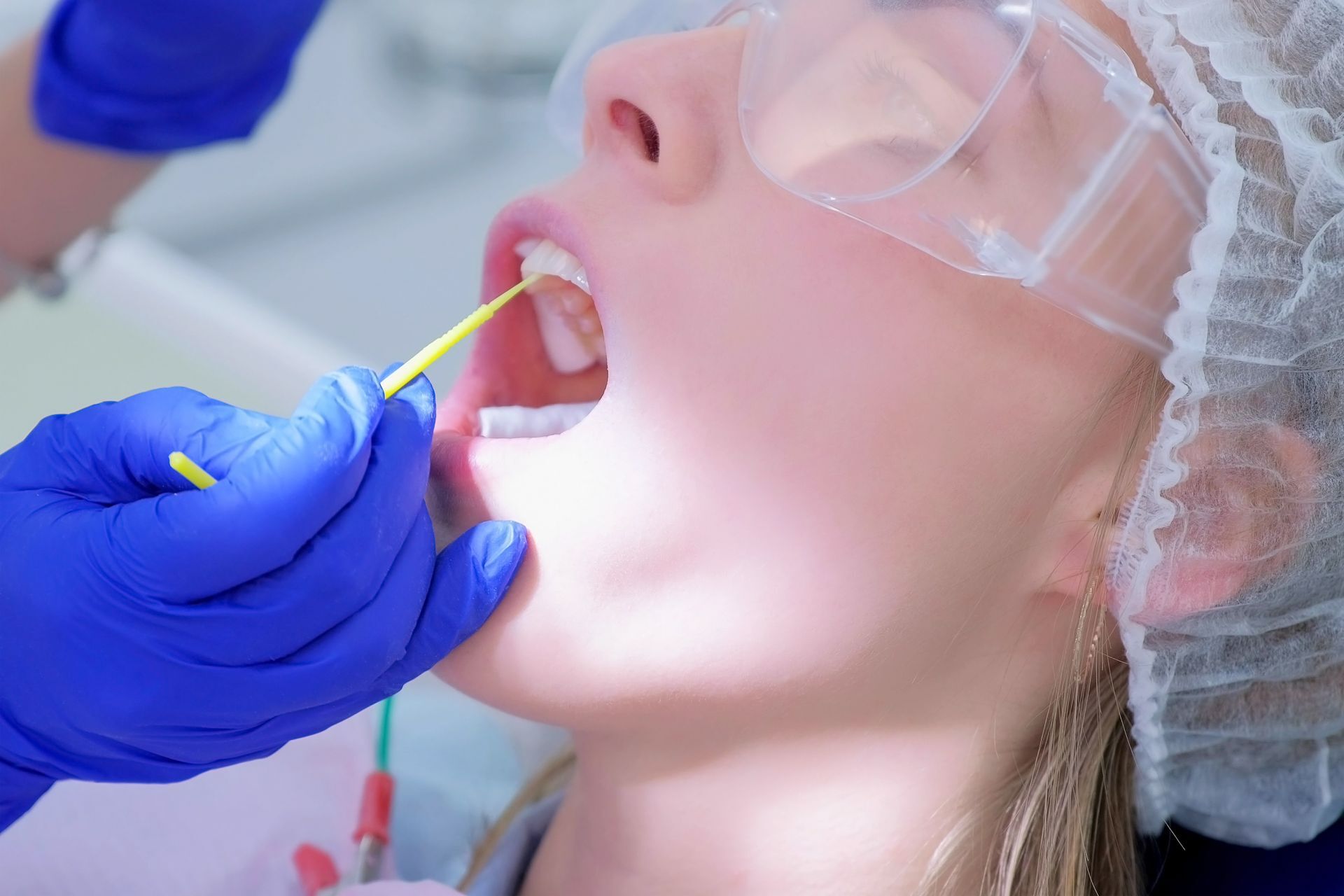 Behandlung mit Fluorid-Lack Versiegelung